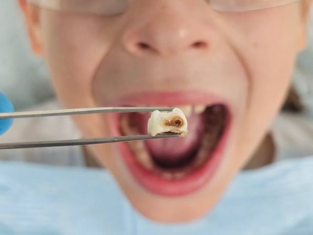 Best Emergency Wisdom Tooth Extraction in Chesterfield, SC