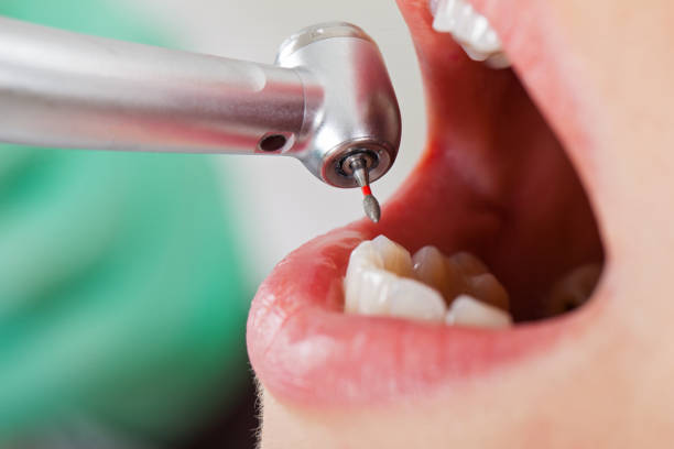 Best Broken or Chipped Tooth Repair in Chesterfield, SC